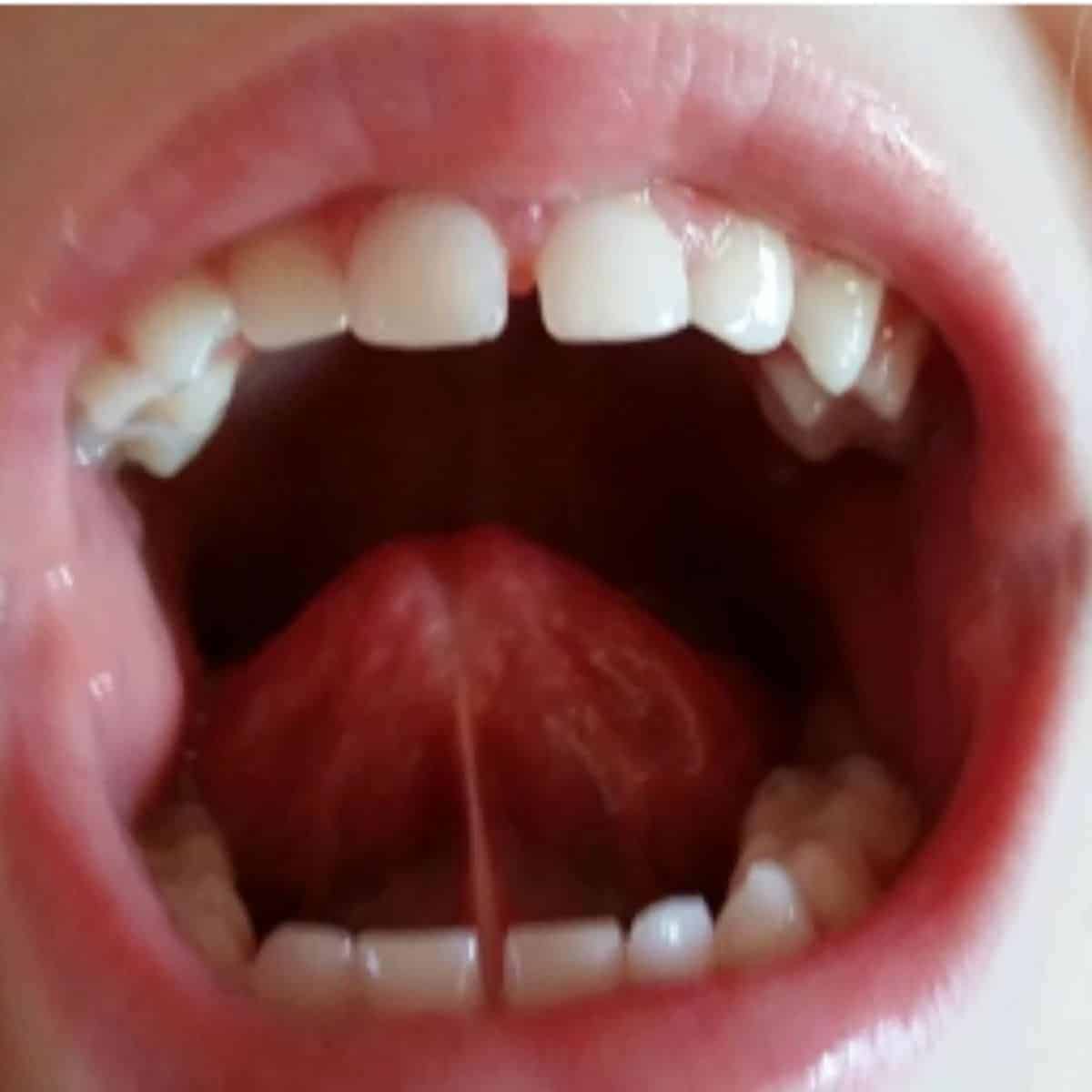 30+ Tongue Tie Signs and How to Treat Them - Your Kid's Table