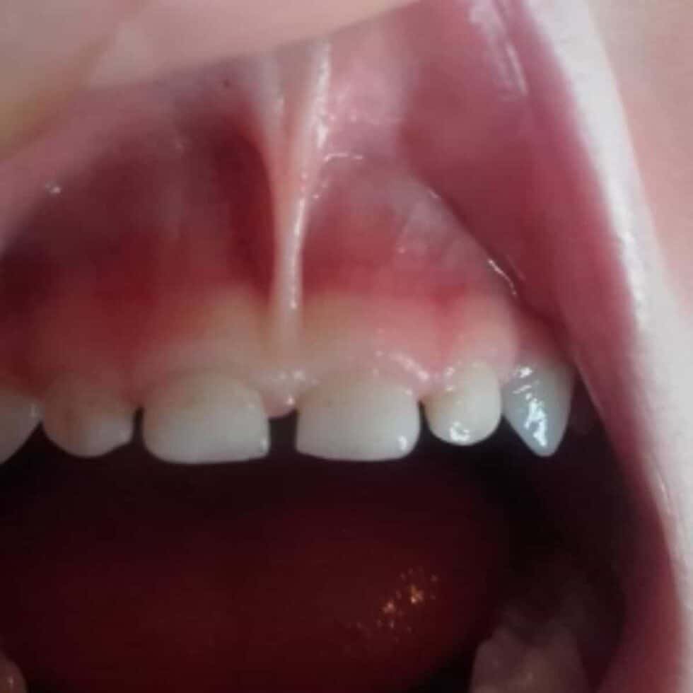 30+ Tongue Tie Signs and How to Treat Them Your Kid's Table